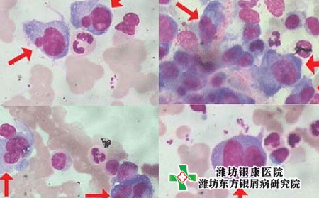 鎮江銀屑病醫院-鎮江銀屑病醫院哪里有效果