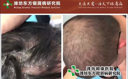 16歲的浩浩在濰坊銀屑病醫院治療后