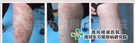 銀屑病圖片癥狀_銀屑病治療前中后