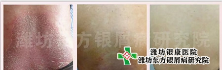 銀屑病圖片_銀屑病治療前中后