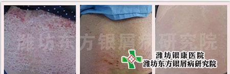 銀屑病癥狀_銀屑病治療前中后
