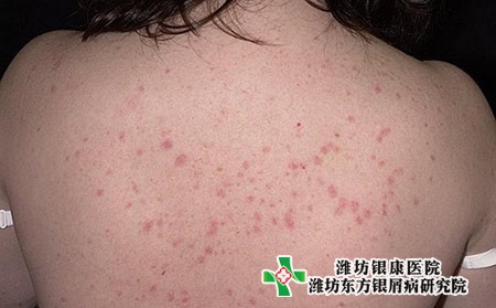 牛皮膚癬圖片大全_早期牛皮膚癬的癥狀是什么 牛皮膚癬圖片大全_早期牛皮膚癬的癥狀是什么