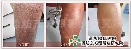 牛皮癬治療前中后