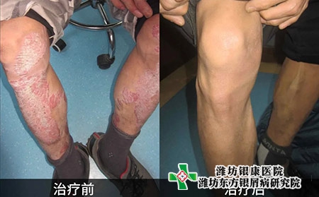 牛皮癬治療對比圖