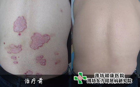 牛皮癬案例病例