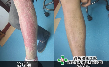 牛皮癬治療前牛皮癬治療后
