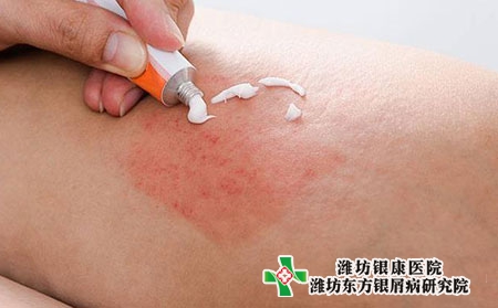 牛皮癬燙傷了怎么辦?牛皮癬與生活習性的關系?