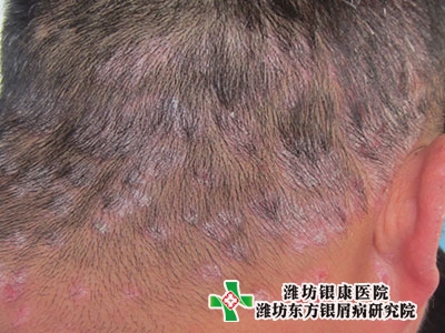 頭皮銀屑病幾種類型是頭皮屑嗎