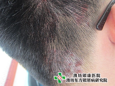 頭皮銀屑病早期圖片診斷