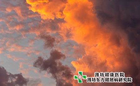 銀屑病應該怎么治療?治療原則是什么?