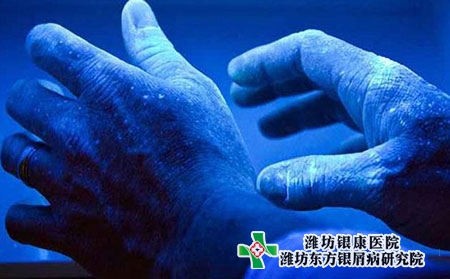 什么是膿皰型牛皮癬?點狀牛皮癬會傳染嗎?