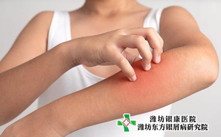 什么是牛皮癬日常注意什么?