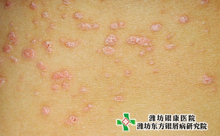 牛皮癬的發病特征和癥狀是什么_蘇州牛皮癬疾病專家