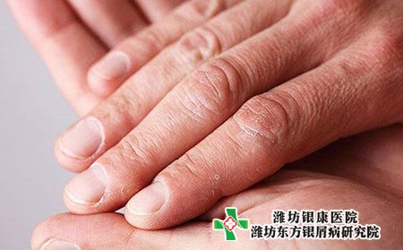 常見牛皮膚癬圖片幾種類型圖片和說明 常見牛皮膚癬圖片幾種類型圖片和說明