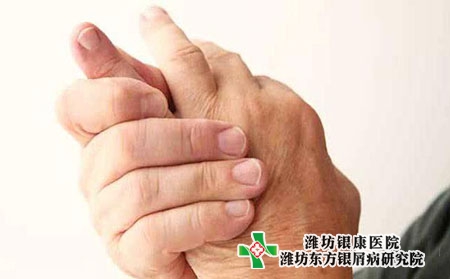 手掌臉部牛皮膚癬的圖片癥狀頭上圖片