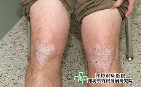 牛皮膚癬癥狀的圖片表現有哪些