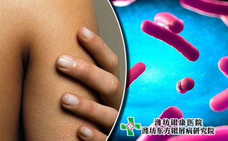 牛皮癬的臨床癥狀特點(diǎn)有哪些?診斷癥狀特點(diǎn)有哪些?