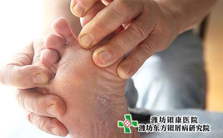 牛皮癬具有遺傳性好發人群有哪些?