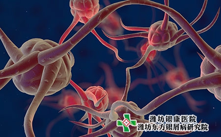 日照治療銀屑病的醫(yī)院哪里治的好 日照治療銀屑病的醫(yī)院哪里治的好