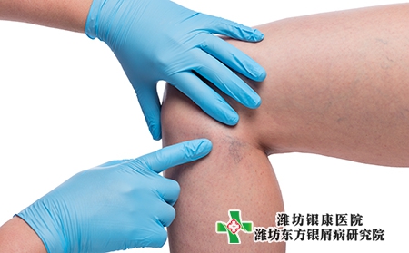 銀屑病不同類型癥狀有哪些?治療方法有哪些? 銀屑病不同類型癥狀有哪些?治療方法有哪些?