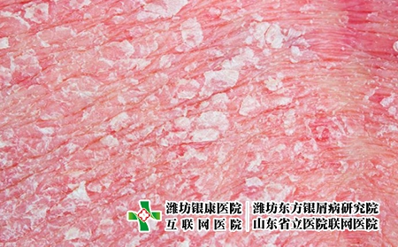 紅皮型銀屑病的早期癥狀圖片