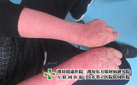 紅皮型銀銀屑病早期特征