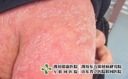 紅皮型銀屑病的早期癥狀表現
