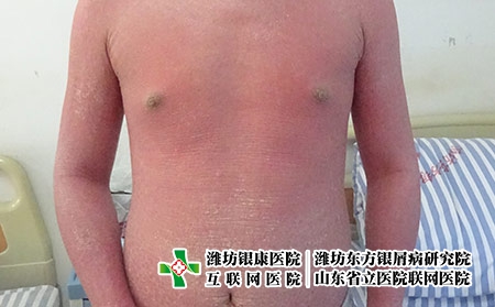 早期的紅皮型銀銀屑病咋治