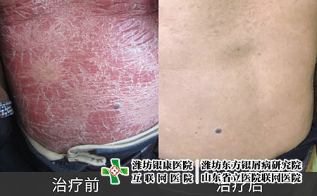牛皮癬治療前和治療后圖片