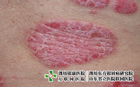 斑塊狀銀屑病圖片癥狀
