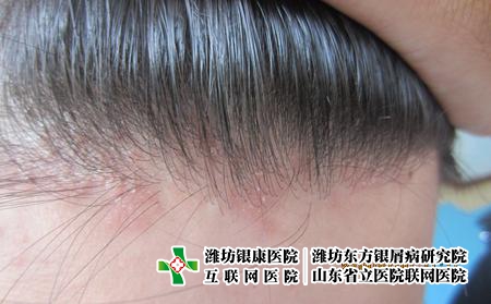 頭皮牛皮膚癬圖片癥狀