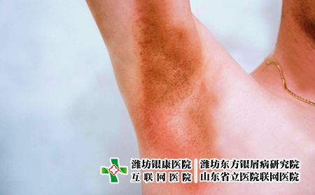 褶皺牛皮膚癬圖片癥狀