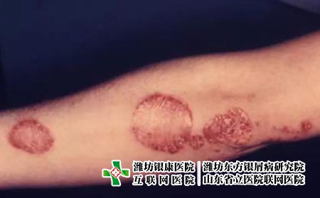 關節型牛皮膚癬圖片癥狀