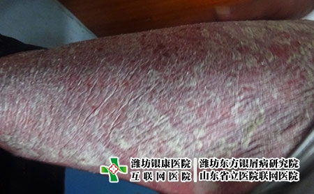 膿皰型牛皮膚癬圖片癥狀