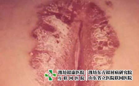 臀裂斑塊狀牛皮頑癬圖片癥狀 臀裂斑塊狀牛皮頑癬圖片癥狀