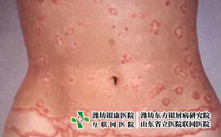 軀干斑塊狀牛皮癬 軀干斑塊狀牛皮癬
