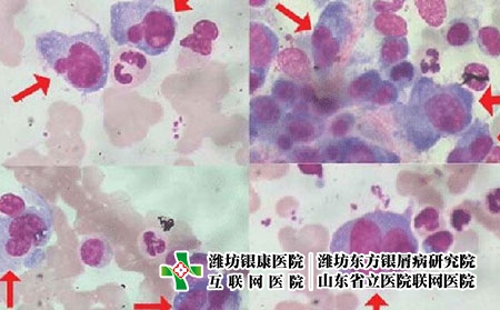 銀屑病發病原因