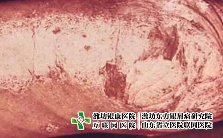 肘部斑塊狀牛皮頑癬圖片癥狀