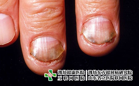 灰指甲癥狀圖片