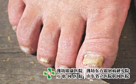 灰指甲治療用什么藥