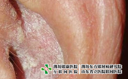 耳朵銀屑病-耳部銀屑癬圖片