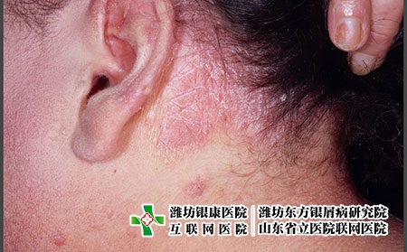 耳朵銀屑病-耳部銀屑癬癥狀