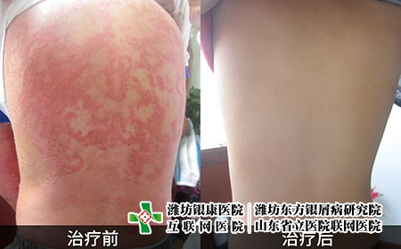 牛皮屑治療對比前后圖片