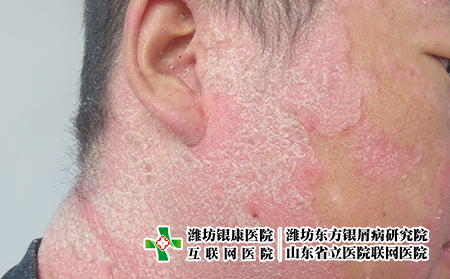 臉部牛皮膚癬什么特征