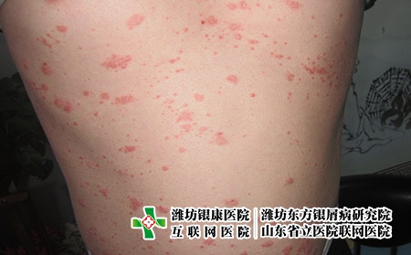 點滴狀牛皮膚癬有什么發病因素