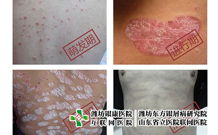 銀皮癬發(fā)展過程-銀皮癬怎么治才能斷根
