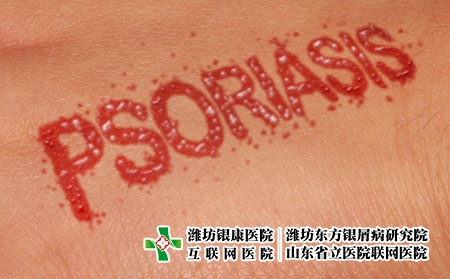 銀屑病2022年有望攻克