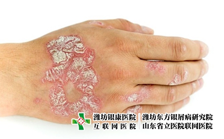 牛皮癬的發(fā)病特征和癥狀