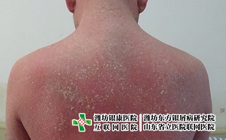 紅皮病型銀屑病