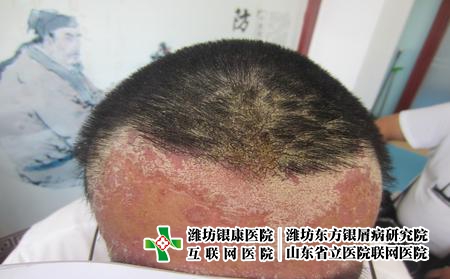 牛皮癬的多發(fā)部位都有哪些癥狀?濰坊哪些醫(yī)院治銀屑病醫(yī)院比較好 牛皮癬的多發(fā)部位都有哪些癥狀?濰坊哪些醫(yī)院治銀屑病醫(yī)院比較好